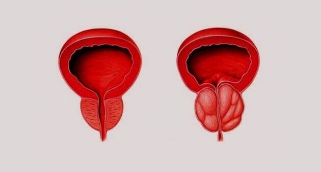 Zdravá prostata (vľavo) a zapálená v dôsledku prostatitídy (vpravo)