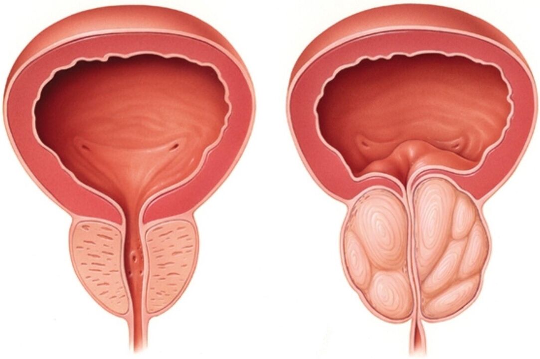 Normálna prostata (vľavo) a so známkami zápalu pri prostatitíde (vpravo)