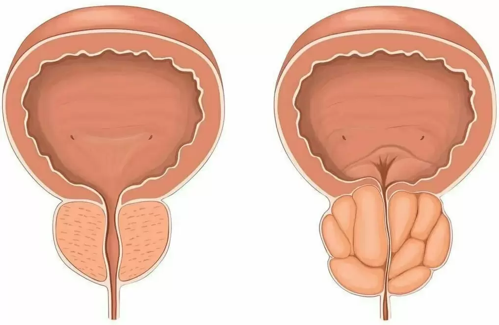 Normálna prostata a bolesť prostaty