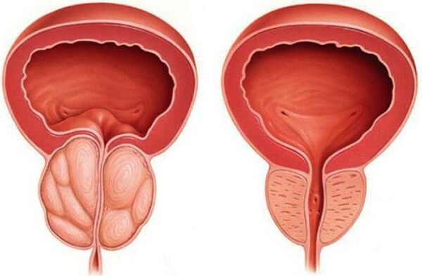 zdravá a zapálená prostata s prostatitídou
